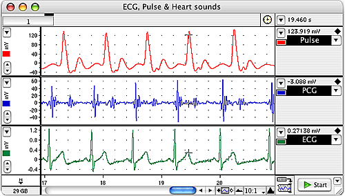 Elektrokardiogramm des Herzens